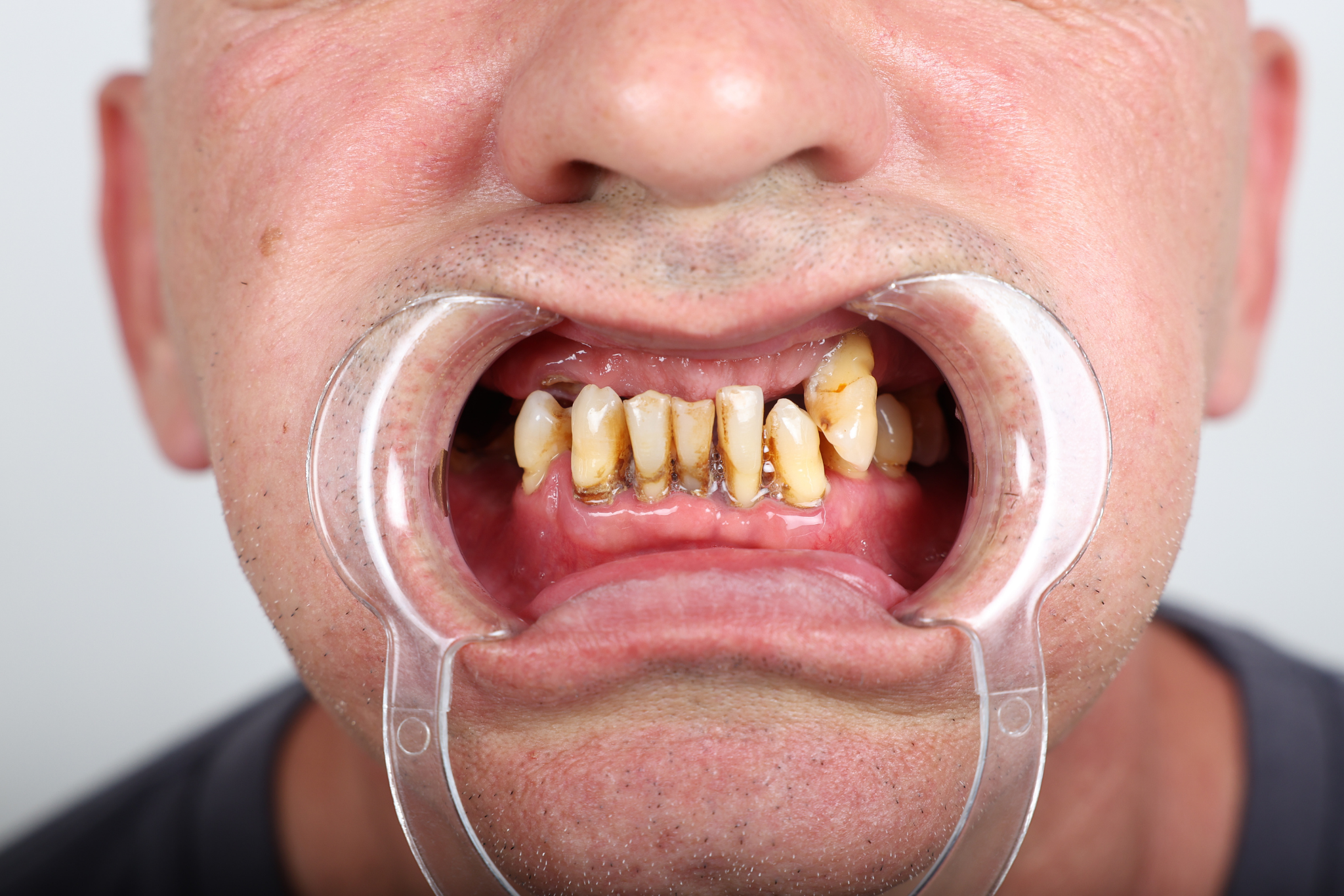 Before All-on-6 Implant Treatment